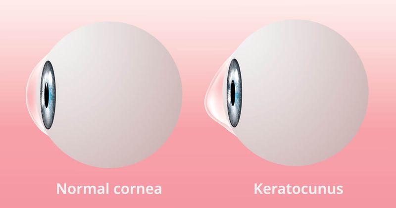 Keratoconus informational image