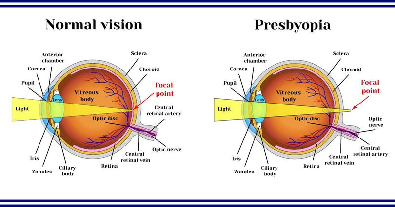 Presbyopia