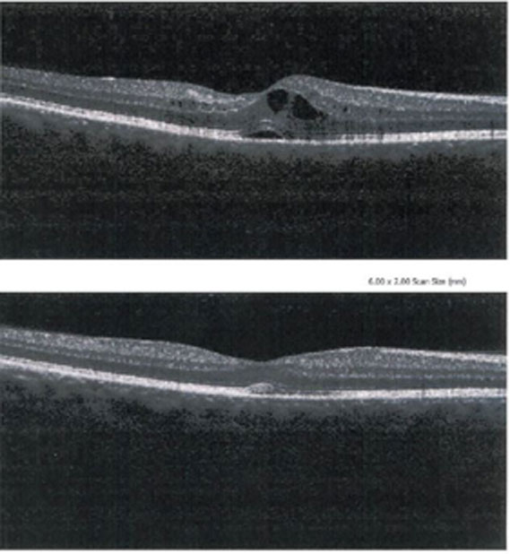 CME shown via OCT 4 weeks postop, Bottom: CME after being treated with prednisolone acetate 1% and ketorolac 0.5%, four times daily for 4 additional weeks. 