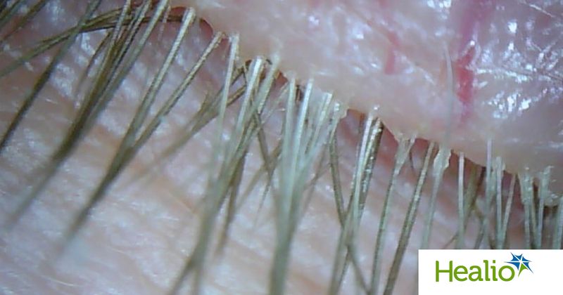 Clinical image showing a close up of demodex on eyelashes