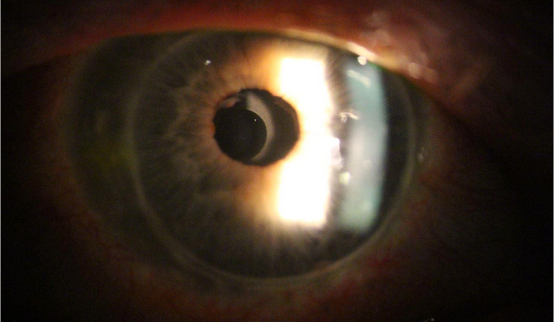 An Apthera small-aperture lens implanted in an eye that had previously undergone a penetrating keratoplasty for keratoconus