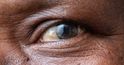 Peripheral neuropathy associated with dry eye disease in patients with diabetes