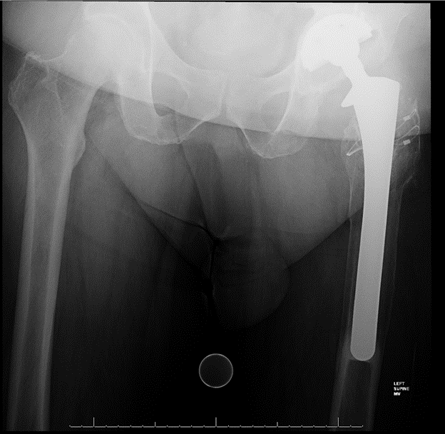 Figure 1. Radiographs at the time of presentation revealed a cementless acetabular component (A) and a 21-mm extensively coated, long stem in place with severe proximal femoral stress shielding (B).