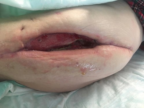 Figure 2. After 6 weeks of IV antibiotics and negative pressure open wound management, the patient was referred to OrthoCarolina for definitive treatment.