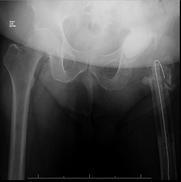 Figure 3. Because of the severe proximal femoral bone loss from the infection, as well as stress shielding, an articulating spacer was unable to be placed (A). Therefore, a static spacer was used (B). 