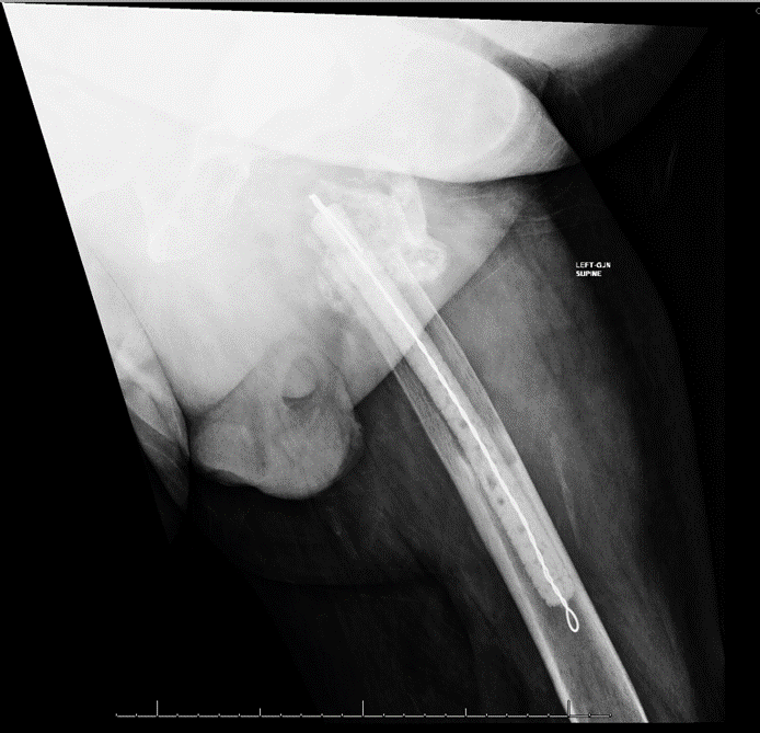 Figure 3. Because of the severe proximal femoral bone loss from the infection, as well as stress shielding, an articulating spacer was unable to be placed (A). Therefore, a static spacer was used (B). 