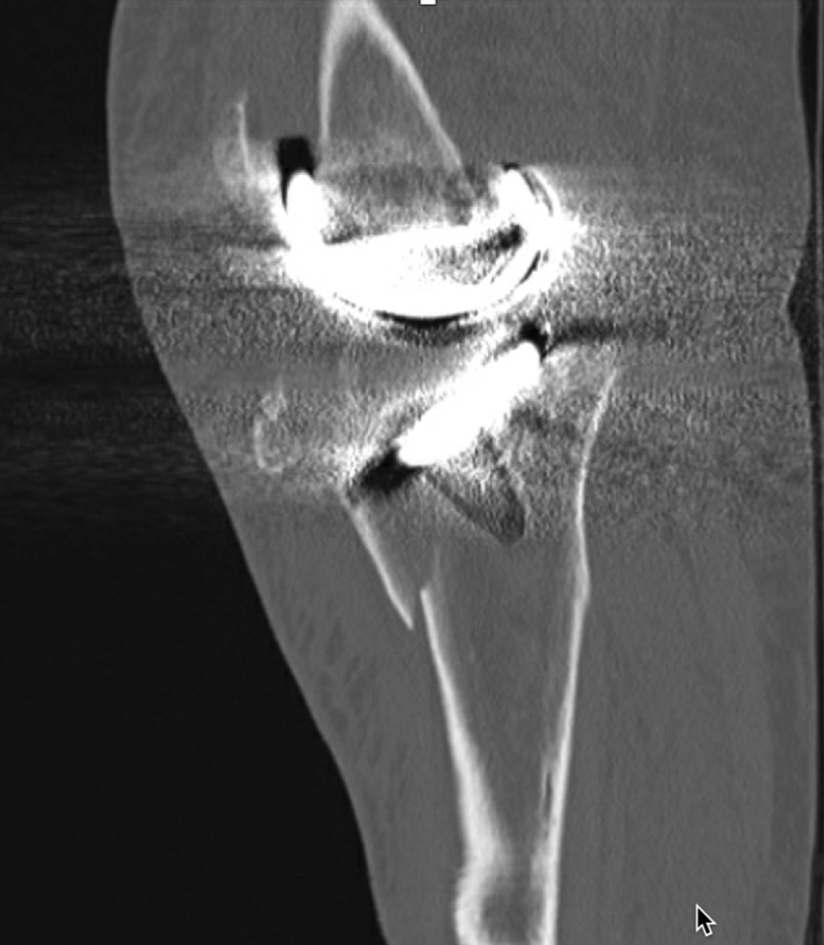 CT scan obtained at an outside emergency room showed a complex periprosthetic tibia fracture with a loose tibial component.