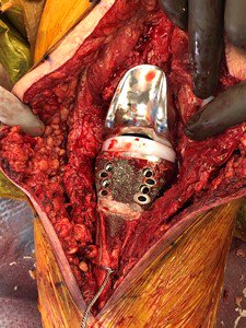 The femur was reamed and cut to accept a 3-cm resurfacing femoral component with a 150-mm stem being careful to externally rotate the implant to allow for proper patellar tracking. The appropriate poly insert was selected, and the hinge assembled.