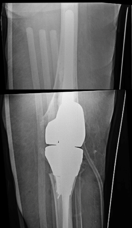 The immediate postoperative AP and lateral radiographs demonstrating a long-stem hinged prosthesis with reduced tibial tubercle.