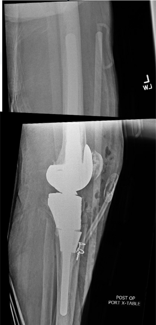 The immediate postoperative AP and lateral radiographs demonstrating a long-stem hinged prosthesis with reduced tibial tubercle.