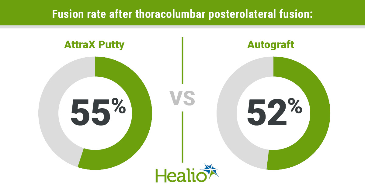 Patients undergoing thoracolumbar posterolateral fusion had a fusion rate of 55% with AttraX Putty and 52% with autograft.