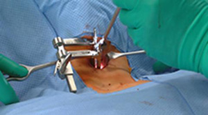 total cervical replacement