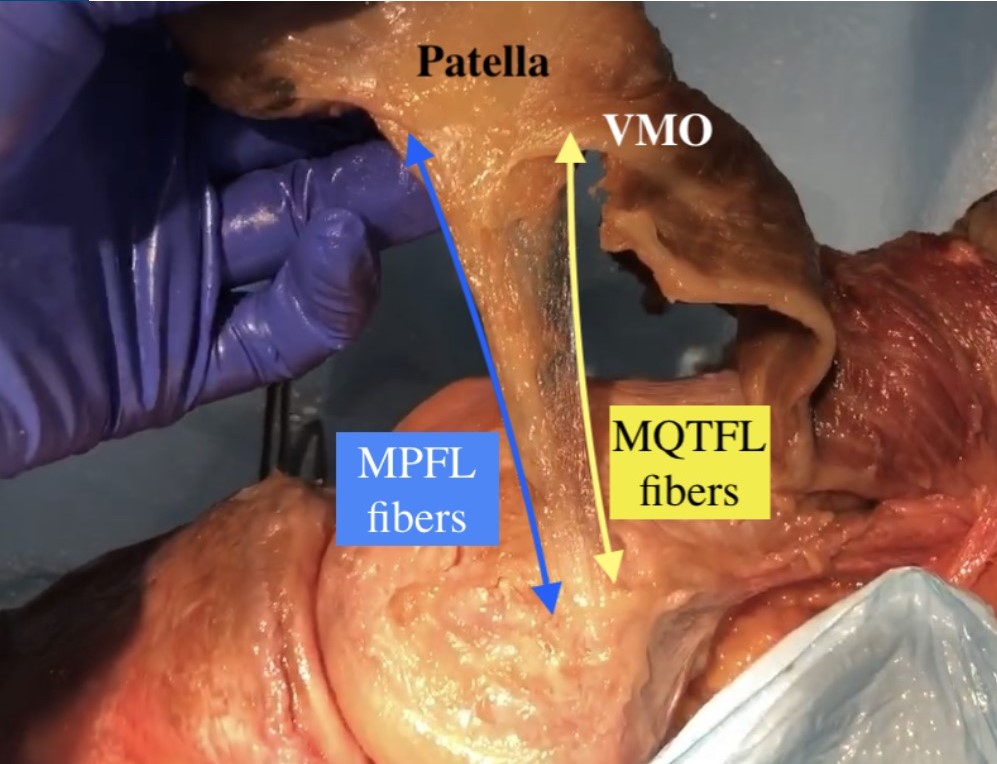 A medial view of a right knee shows the MPFC attachment on the medial femur. Source: Miho J. Tanaka, MD