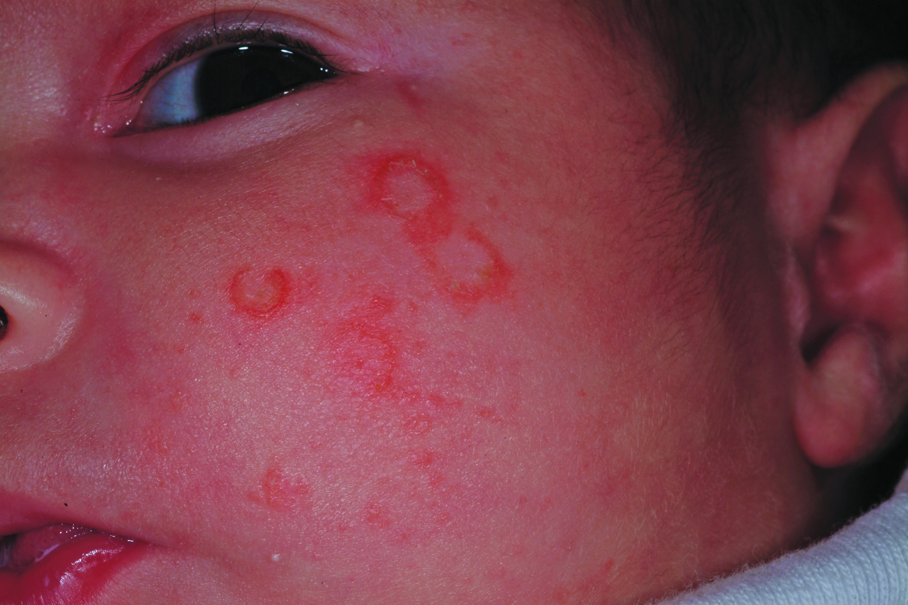 6-week-old infant with rash on her face