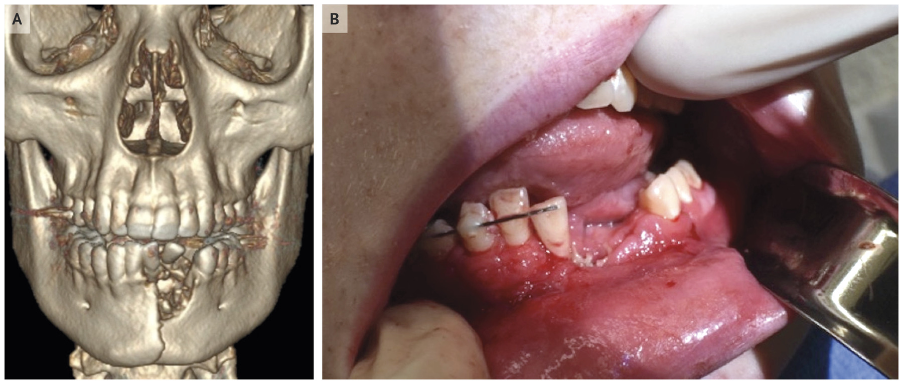 Clinical image of teen injured by e-cigarette