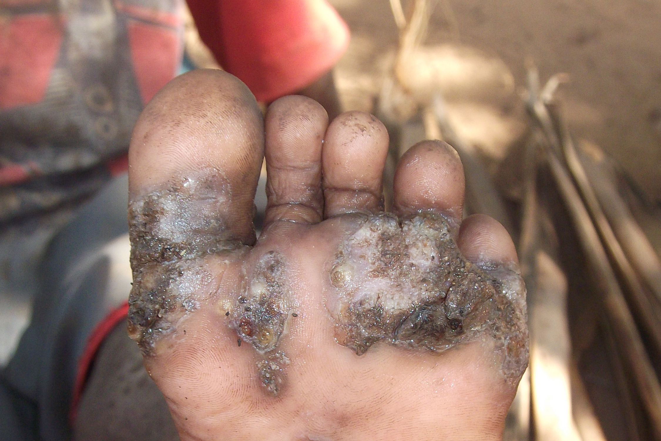 A foot with severe tungiasis