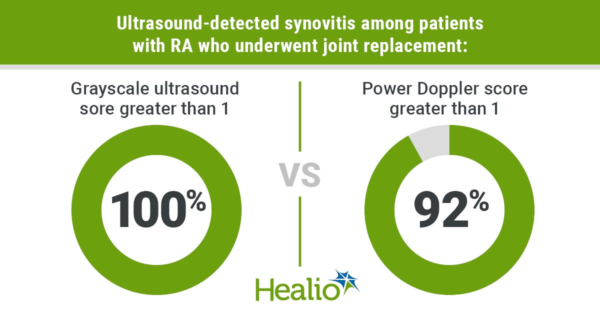 Joint replacement neither eliminates nor prevents ultrasound-detected synovitis among patients with rheumatoid arthritis.