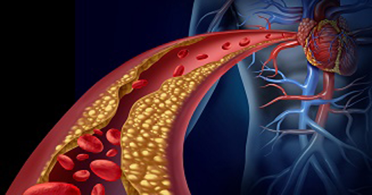 Artery plaque