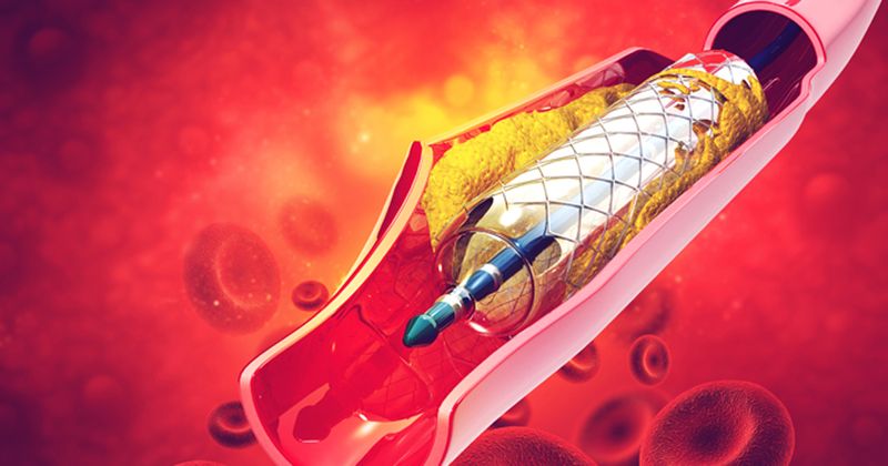 demo of a balloon stent