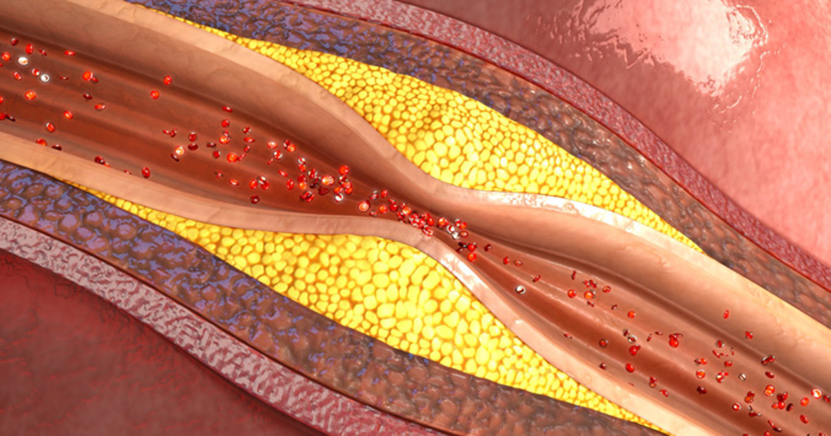 aerial view of blood flow in a clogged artery, Shutterstock