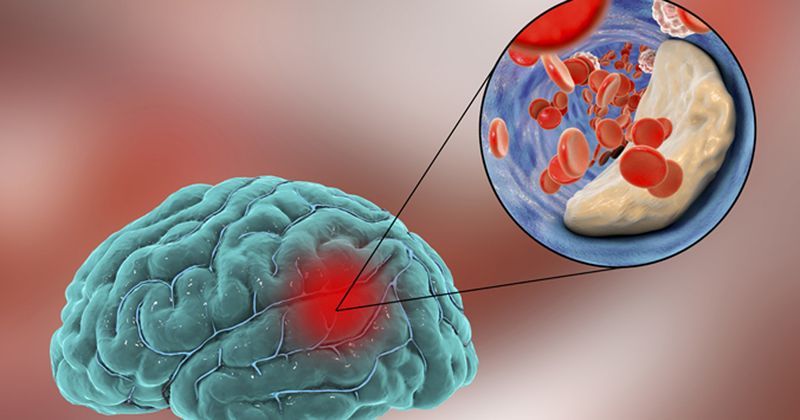 Ischemic Stroke