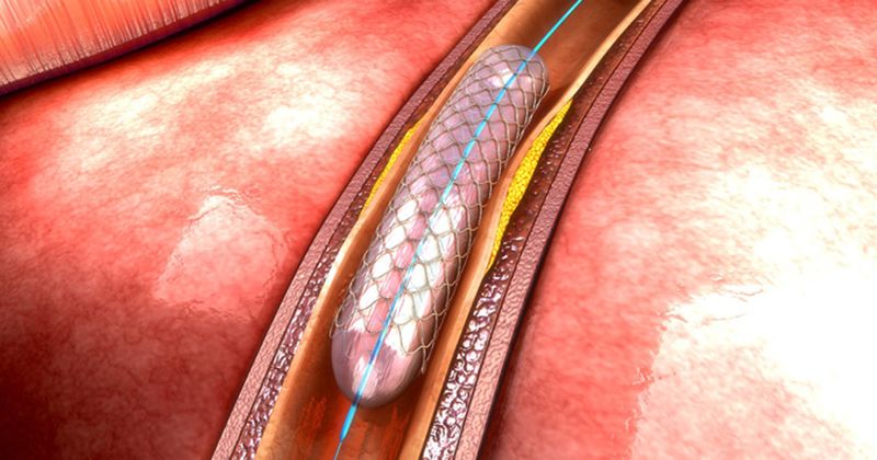 vascular stent