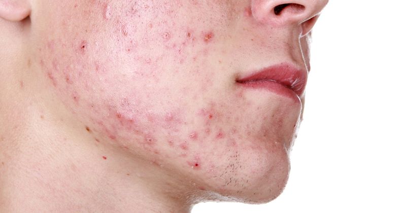 Man with acne on his face