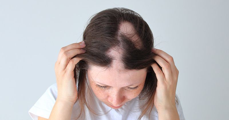 Alopecia 1