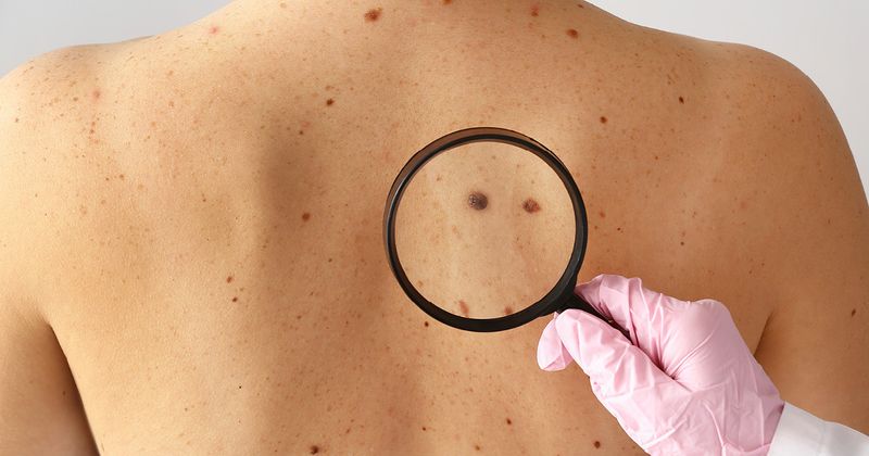 A hand holds a magnifying glass to possibly cancerous lesions on someone's back. 