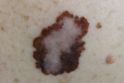 Overall melanoma incidence decreasing among young patients