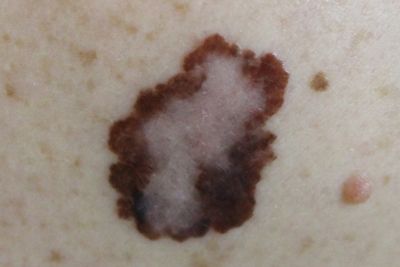 Overall melanoma incidence decreasing among young patients