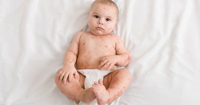 Infants with atopic dermatitis, high-risk factors more likely to experience atopic march