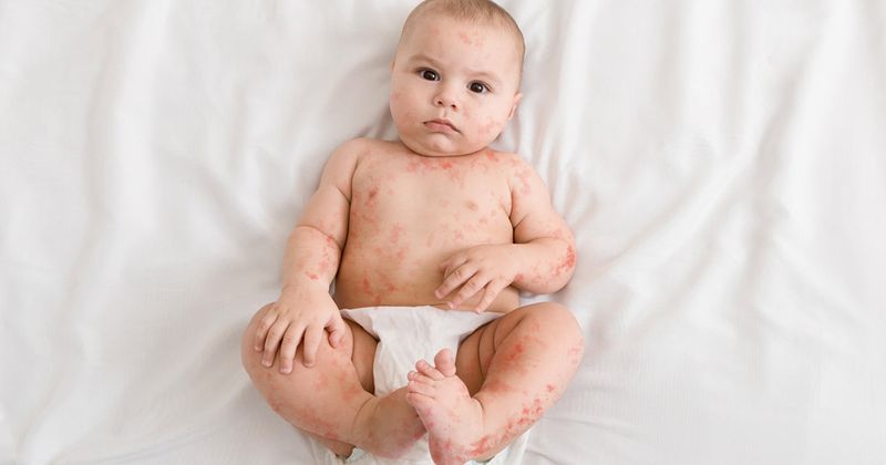 Pediatric rash