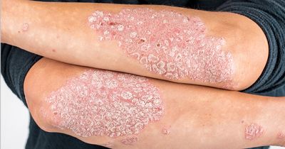 Oral IL-23 inhibitor icotrokinra shows efficacy for plaque psoriasis