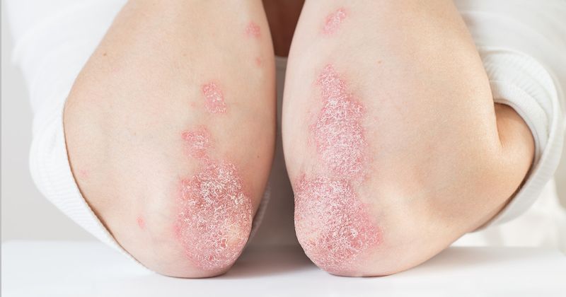 Psoriasis 4