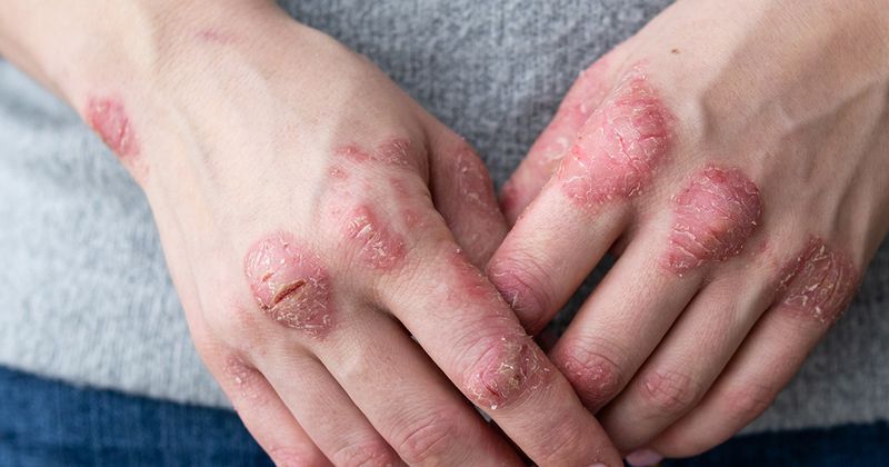 Hands showing psoriasis