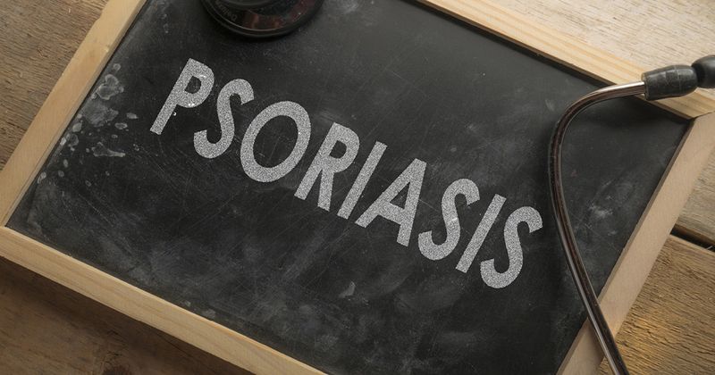 The word psoriasis written on a chalkboard. 