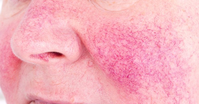 Rosacea 1