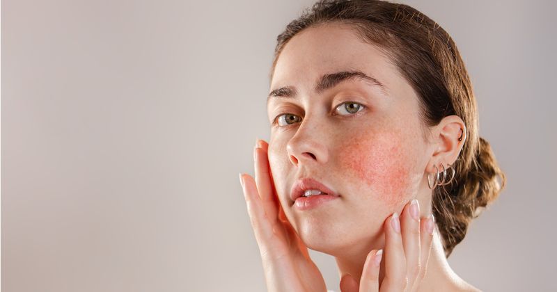 Rosacea 2