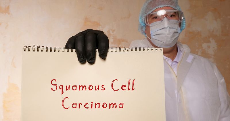 Squamous Cell Carcinoma