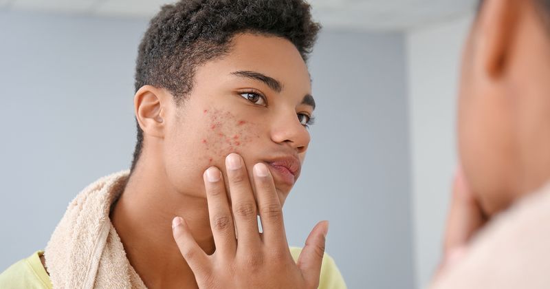 Transgender acne