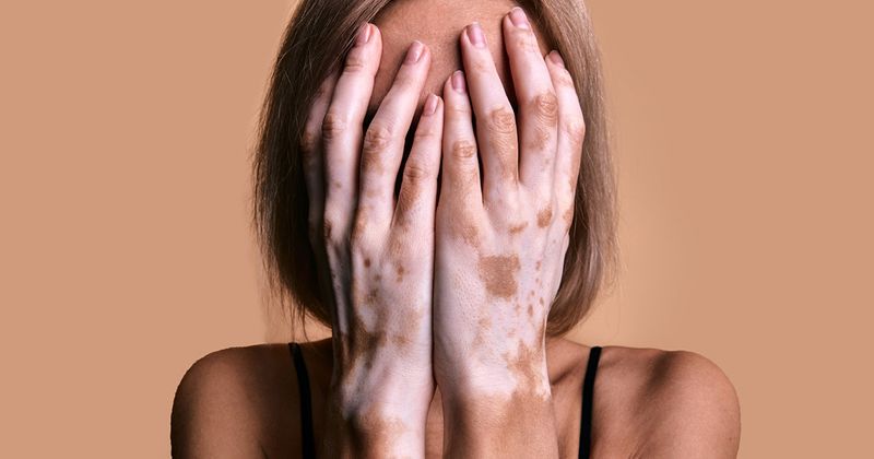 Vitiligo hands