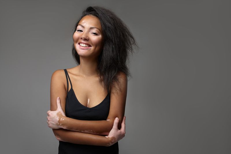 Vitiligo Woman