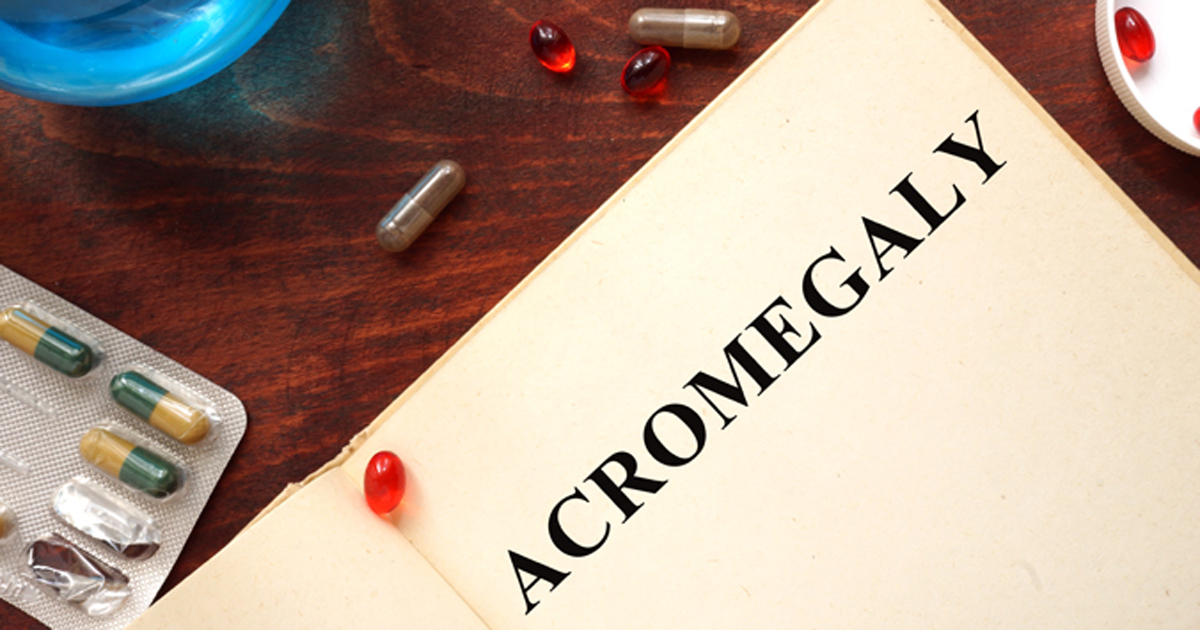 Acromegaly 2019