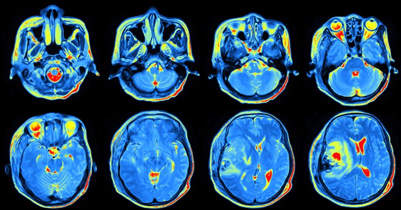 multiple images of a brain scan