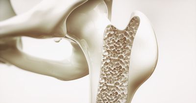 Men, younger women with systemic sclerosis have lower bone mineral density vs controls 