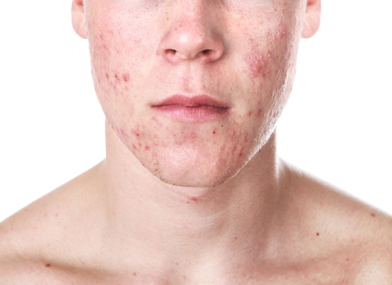 Acne that is slightly severe