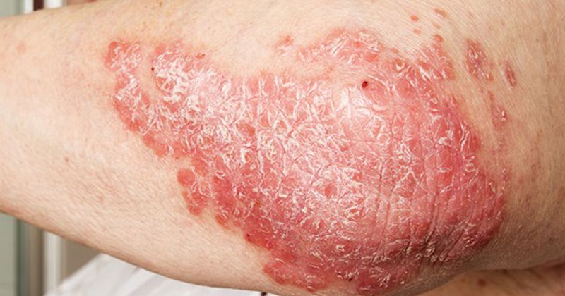 A patch of psoriasis