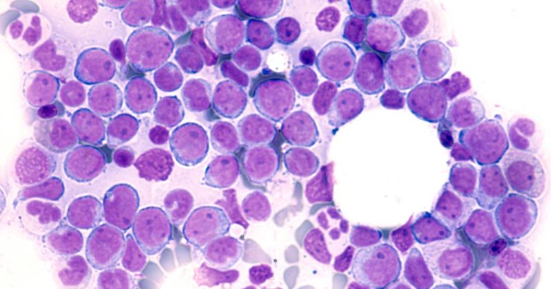 Photomicrograph of bone marrow aspirate showing myeloblasts of acute myeloid leukemia (AML), a cancer of white blood cells.