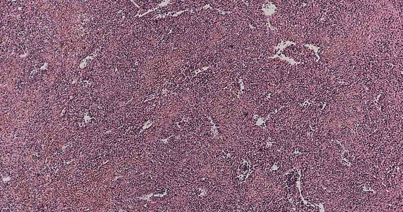  Chronic myeloid leukemia of spleen 